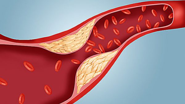 Phác đồ điều trị mỡ máu cần toàn diện