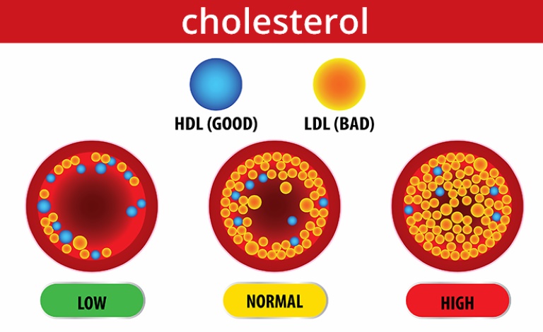 Tăng cholesterol máu