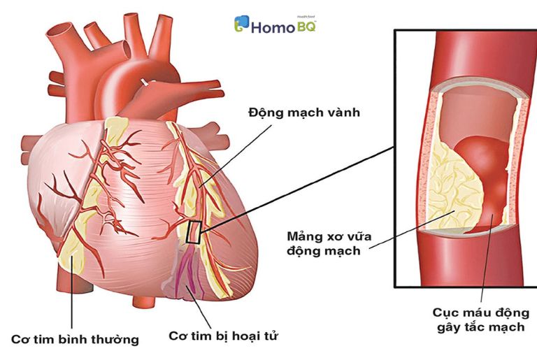 Xơ vữa động mạch là triệu chứng do rối loạn lipid máu gây nên